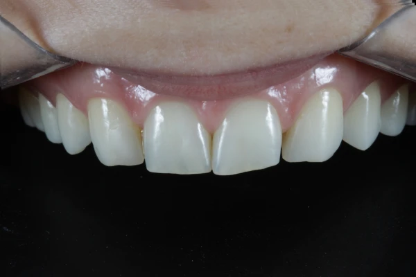 Antes